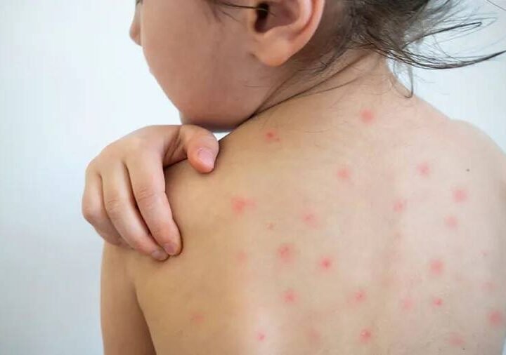 MÉXICO REBASA LOS 10 MIL CASOS DE SARAMPIÓN