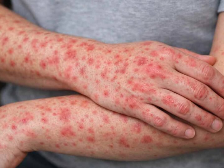 MÉXICO SUMA CASI 14 MIL CASOS DE SARAMPIÓN