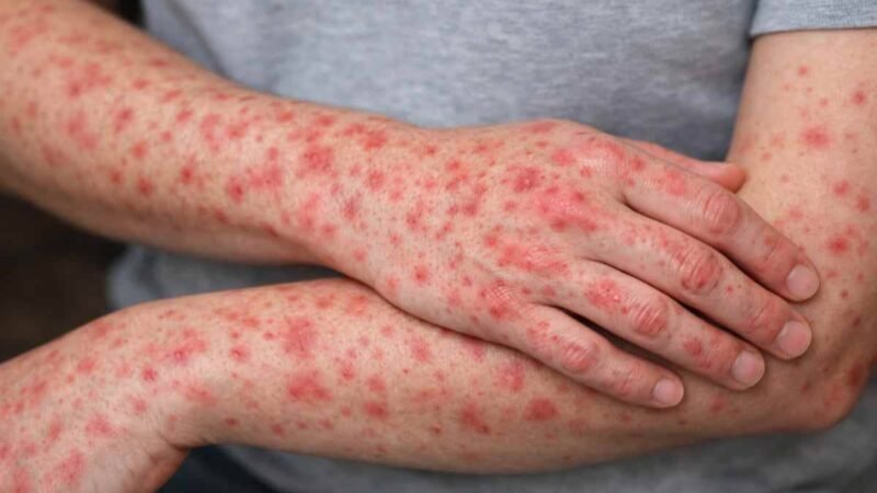 MÉXICO SUMA CASI 14 MIL CASOS DE SARAMPIÓN