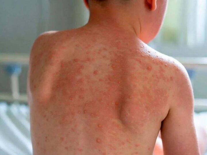 MUEREN DOS NIÑOS POR SARAMPIÓN EN ZACATECAS