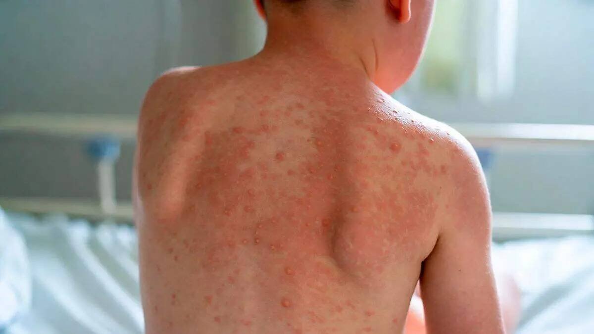 MUEREN DOS NIÑOS POR SARAMPIÓN EN ZACATECAS