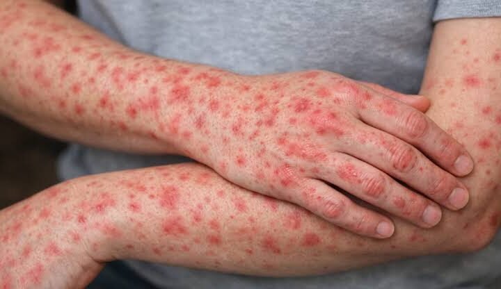 MÉXICO SUPERA 20 MIL CONTAGIOS DE SARAMPIÓN; JALISCO ENCABEZA CASOS