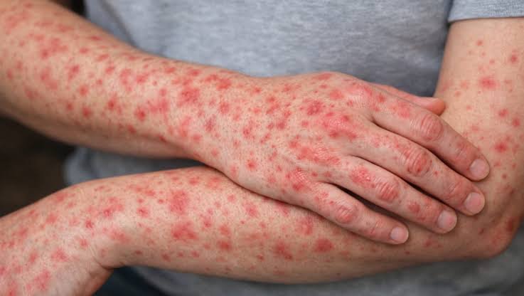 MÉXICO SUPERA 20 MIL CONTAGIOS DE SARAMPIÓN; JALISCO ENCABEZA CASOS